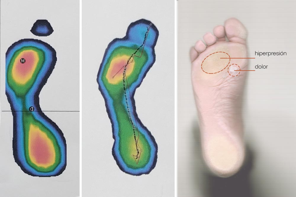 Plantillas3d_sesamoiditis2 sesamoiditis