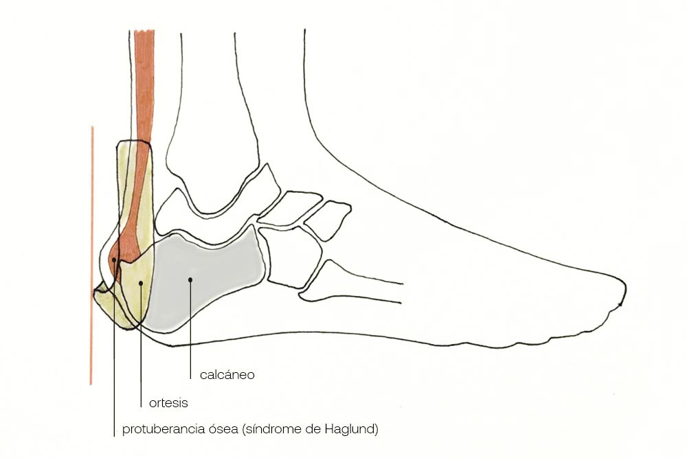 ferula3d_haglund02b sindrome de haglund