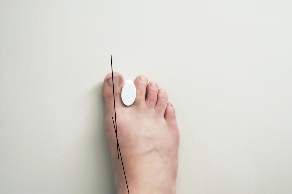 ferula3d_separadorDedos_03 corrector juanete