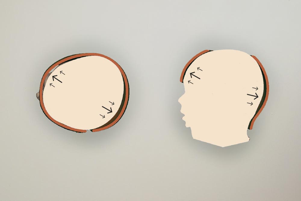 CascoPlagio2 Funcionamiento casco plagiocefalia