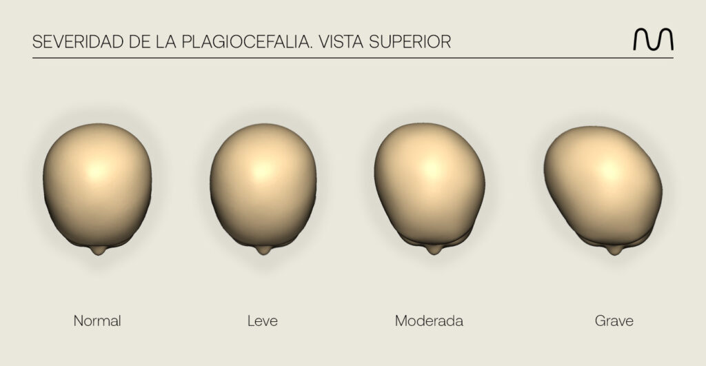 Grados plagiocefalia