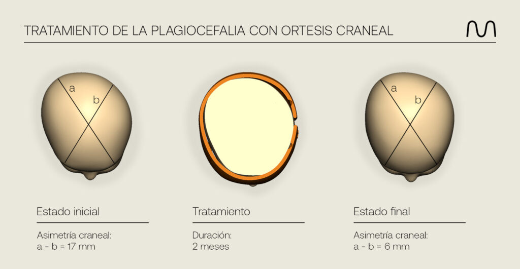 Tratamiento casco plagiocefalia