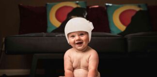 Caso de éxito. Resultados del tratamiento con ortesis craneal caso éxito casco plagiocefalia